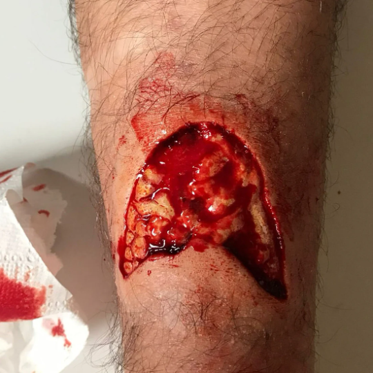 Stor flænge / dybt snitsår – indkapslet silikoneprotese 7,5 x 7,5 cm – hovedbillede